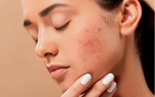 acne-visage